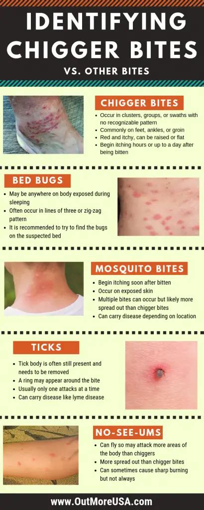 Identifying chigger bites - including pictures, treatment, and remedy ...