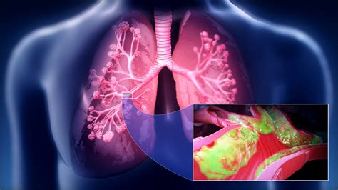 Mucus in lungs | General center | SteadyHealth.com