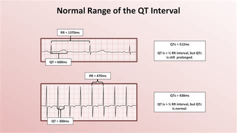 Qtc Normal Range