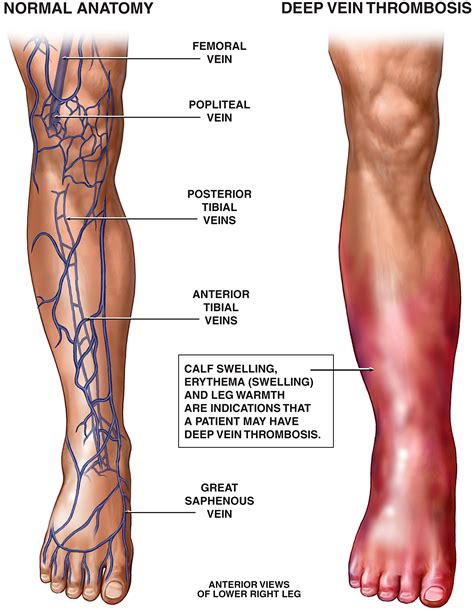 Symptoms Of Blood Clot In Leg After Pregnancy