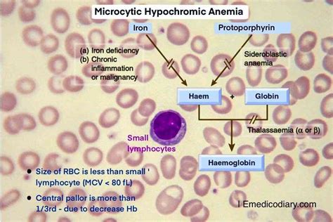 Microcytic hypochromic anemia - Emedicodiary