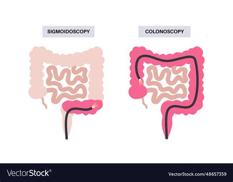 Colonoscopy and sigmoidoscopy Royalty Free Vector Image