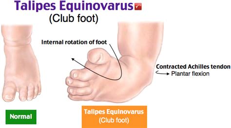 talipes equinovarus - Liberal Dictionary