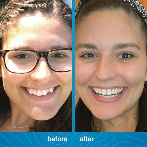 Invisalign Before and After PhotosDr. Jacquie Monroe Ortho