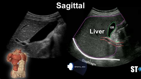 Liver Anatomy and Protocol – Sonographic Tendencies