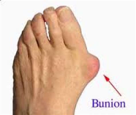 Bunions Causes and Treatment