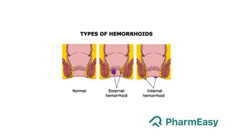 Rubber Band Ligation for Piles: Preparation, Recovery and Risks ...