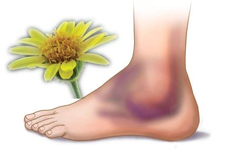 Remedies for Bruises using Arnica ~ Overcoming Diseases