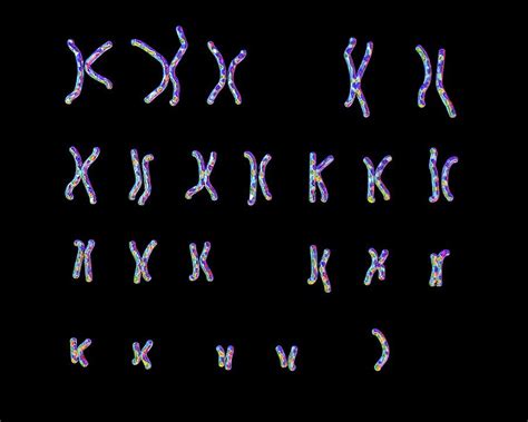 Turner's Syndrome Karyotype Photograph by Kateryna Kon/science Photo ...