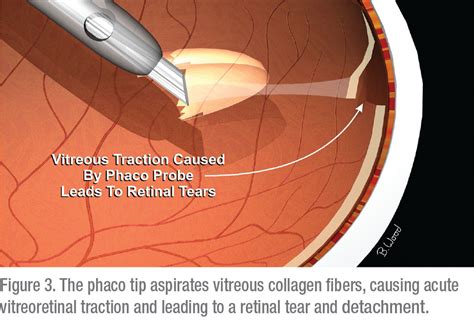 Pars Plana Vitrectomy EyeWiki