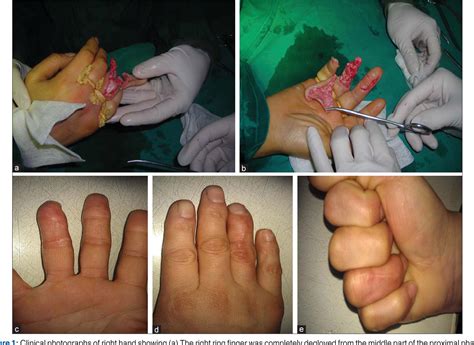 Figure 1 from Replantation of a circumferentially degloved ring finger ...