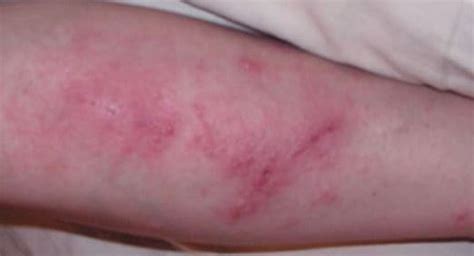 Poison Sumac Rash - Pictures, Treatment, How to Get Rid