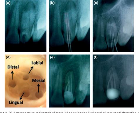 Figure 1 from A maxillary lateral incisor with four root canals ...