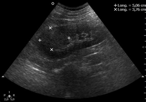 Imagen Thecniques in Renal-Cell Carcinoma | IntechOpen