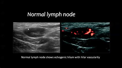 Lymphoma Lymph Nodes Ultrasound