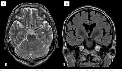 Figure 1 from Hashimoto Encephalopathy Presenting with Acute Psychosis ...