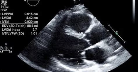 2D Echo Test Cost | 2 D Echocardiography Tests in India