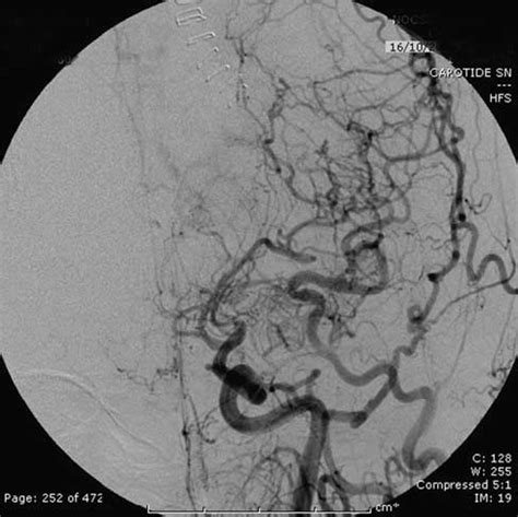 Angiography confirmed the diagnosis of Moyamoya disease | Download ...