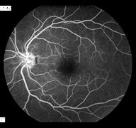 Fluorescein Angiography- Retina Ophthalmology in Frederick MD - Greater ...