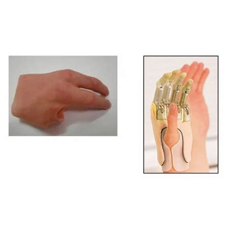 Passive Prosthetic Partial Hand Prosthesis, BOTH, Below the Elbow at ...