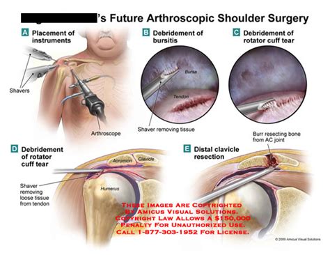 AMICUS Illustration of amicus,surgery,shoulder,arthroscopic,shavers ...