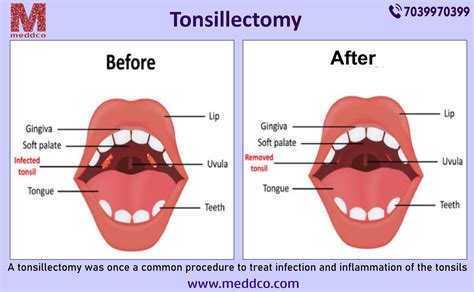 Tonsillectomy Procedure