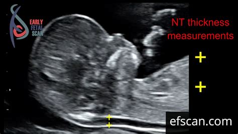 Nuchal translucency (NT) thickness measurement: for Early Fetal Scan ...