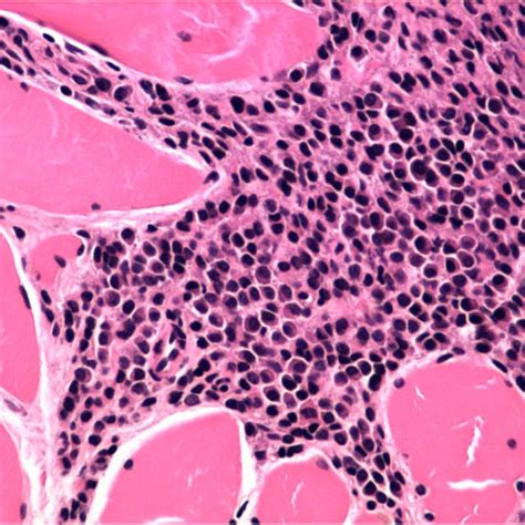 Pleural biopsy. Histological findings of the pleural biopsy showing ...