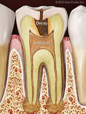 Tooth Pain - Dentist Kitty Hawk, NC - Dental Education Library