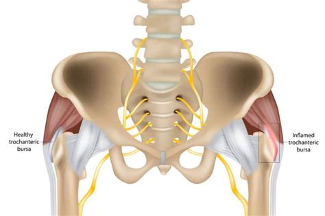 Trochanteric Bursitis Treatment Birmingham - Same Day Treatment