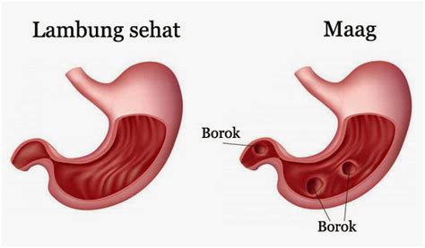 Obat Maag Alami Yang Bagus Dan Paling Ampuh | Obat Tradisional Benjolan ...