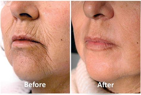 Best Laser Skin Tightening Treatment Orlando Fl | Sanctuary Salon