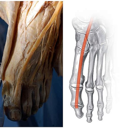 Representative image and schematic drawing of Pattern I tendinous ...