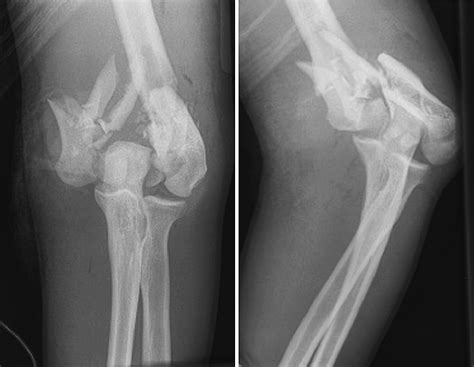 Distal Humerus Fractures - Hand Clinics