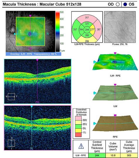 Preoperative Evaluation and Postoperative Management for Epiretinal ...