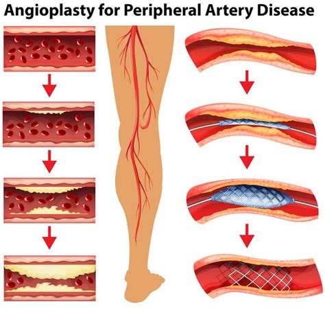 Peripheral Artery Disease Is Common, But Not Unavoidable or Untreatable ...