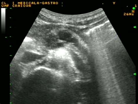 Transabdominal ultrasound image of the pancreatic body: dilated ...