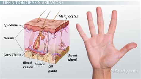 Abrasion Wound Diagram