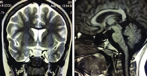 MRI brain demonstrates the sella filled with Cerebrospinal fluid and ...