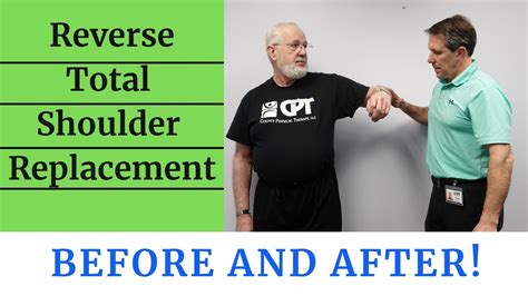 Reverse Total Shoulder Replacement Before & After - YouTube