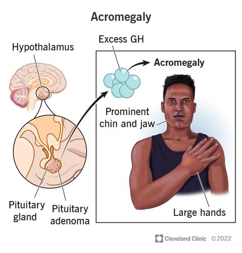 Acromegaly Diagram