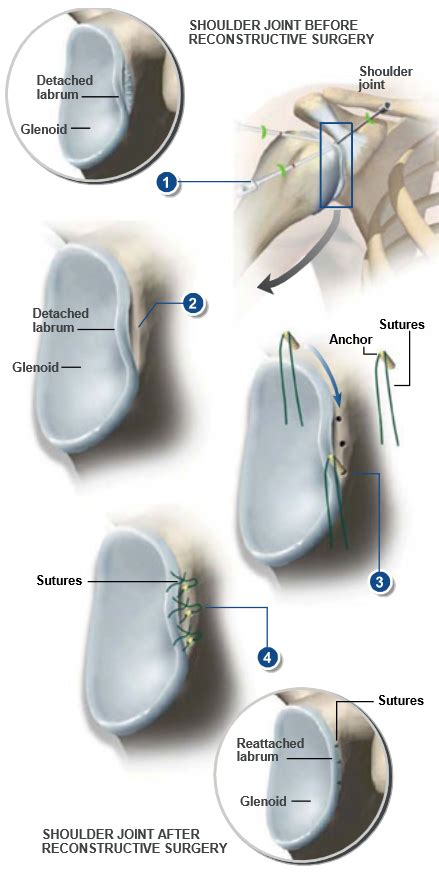 Arthroscopic Bankart Repair | Central Coast Orthopedic Medical Group