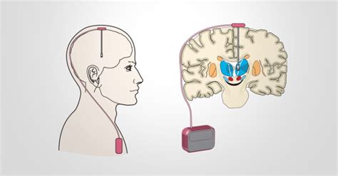 TFG: Design and implementation of algorithm for Deep Brain Stimulation ...