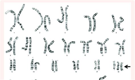 Trisomy 18 (Edward's syndrome) is caused by an abnormality in ...