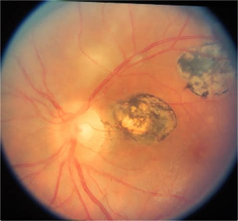 Uveitis, Uveitis Eye - Causes, Types, Symptoms, Diagnosis, Treatment