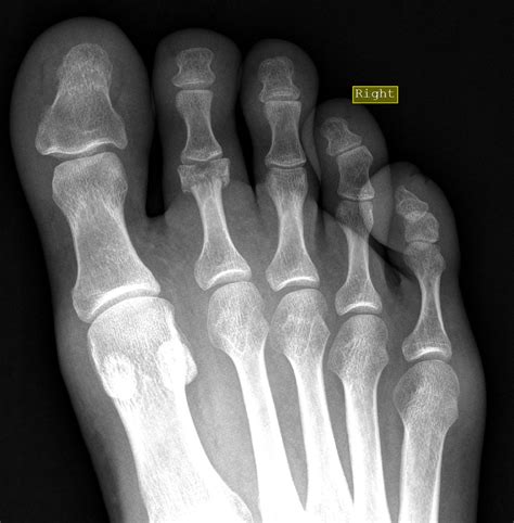 Proximal Phalanges