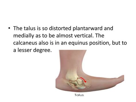 Congenital vertical talus