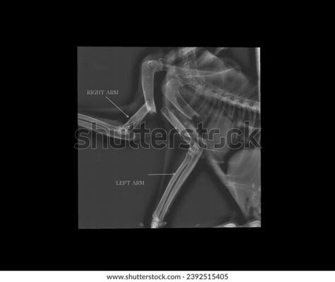 ภาพ ภาพสต็อก วัตถุ 3 มิติและเวกเตอร์เกี่ยวกับ Bilateral femur fractures ...