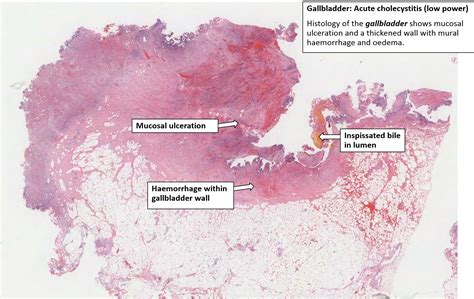 Gallbladder – Acute Haemorrhagic Cholecystitis – NUS Pathweb :: NUS Pathweb