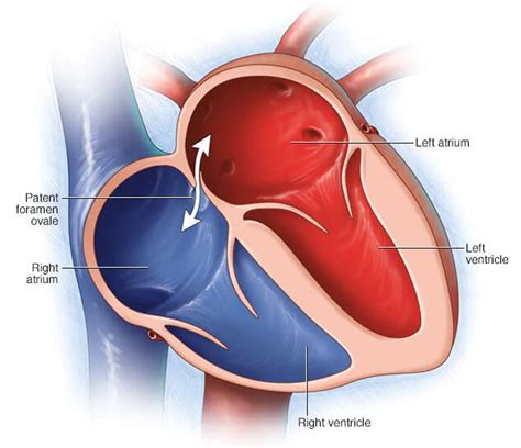 Atrial septal defect repair (ASD) surgery in Iran | Free consultation